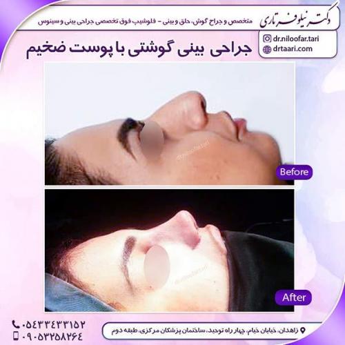 جراحی-بینی-19