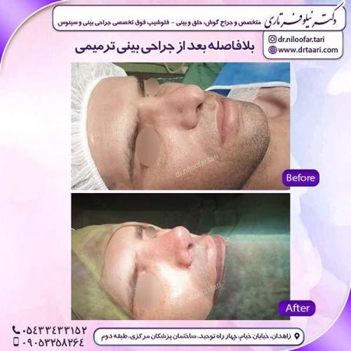 جراحی-بینی-190