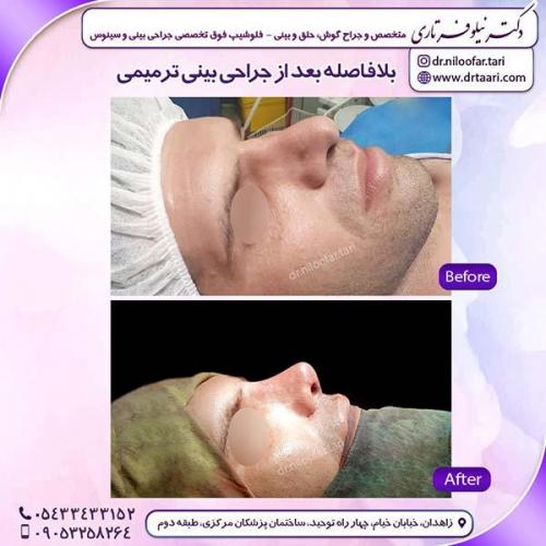 جراحی-بینی-191