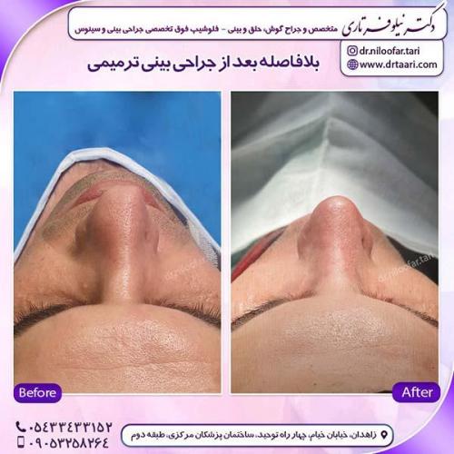 جراحی-بینی-192