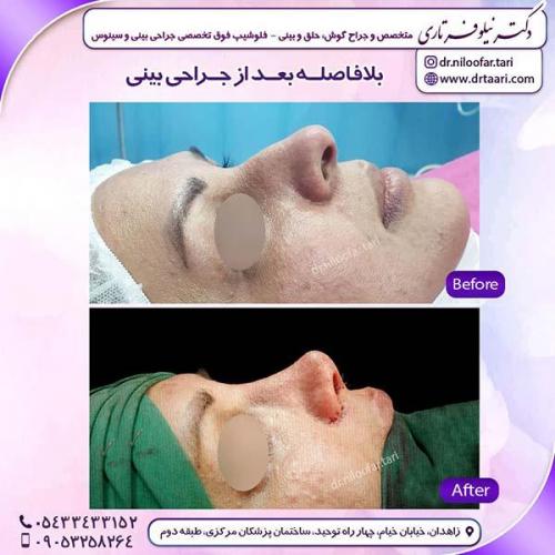 جراحی-بینی-195