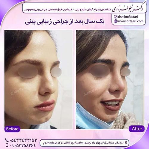 جراحی-بینی-196