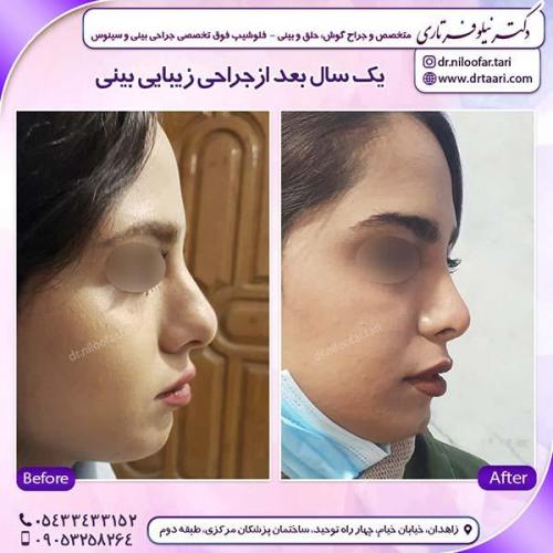 جراحی-بینی-197