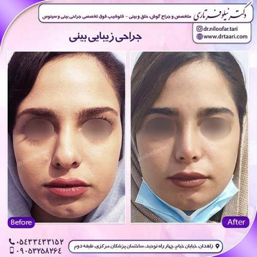 جراحی-بینی-198