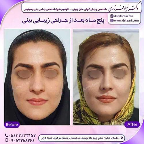 جراحی-بینی-199