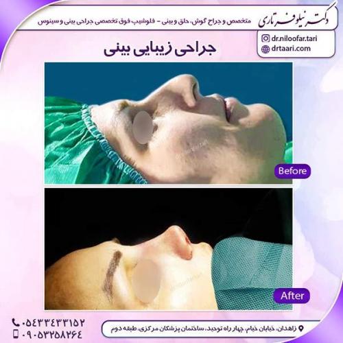 جراحی-بینی-20