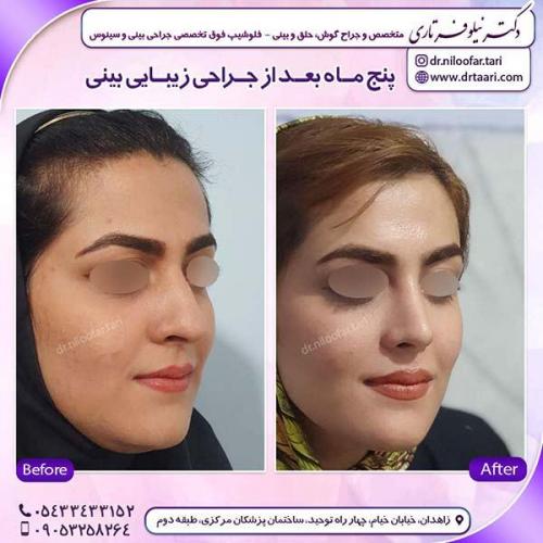 جراحی-بینی-200