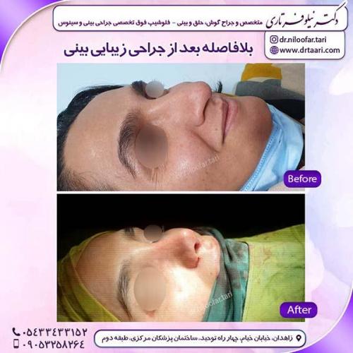 جراحی-بینی-202