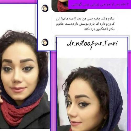 جراحی-بینی-204