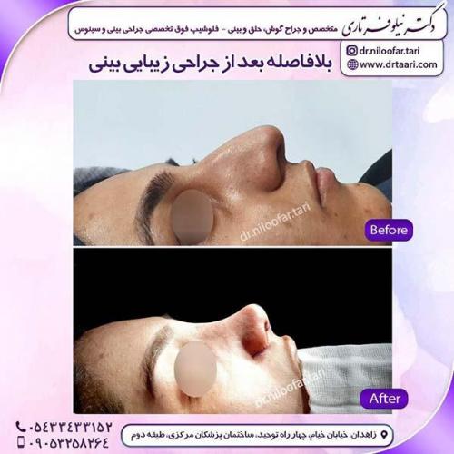 جراحی-بینی-205