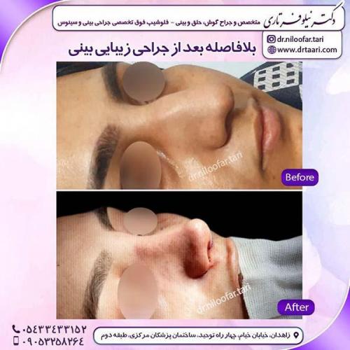 جراحی-بینی-206