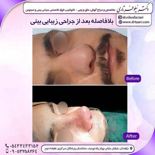 جراحی-بینی-207