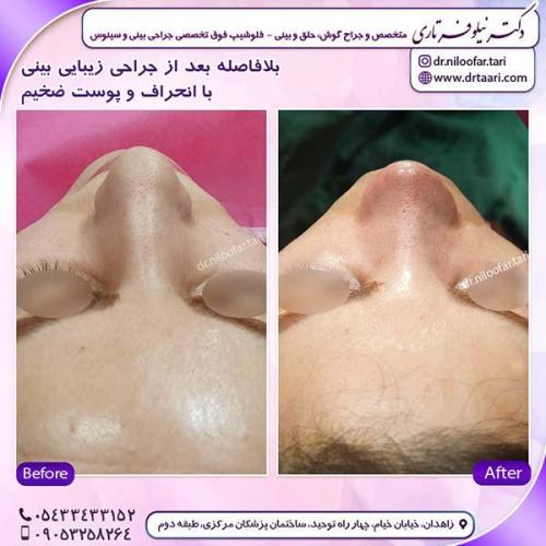 جراحی-بینی-208