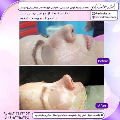 جراحی-بینی-209