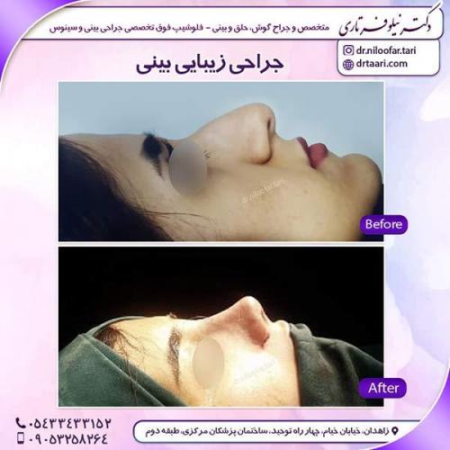 جراحی-بینی-21