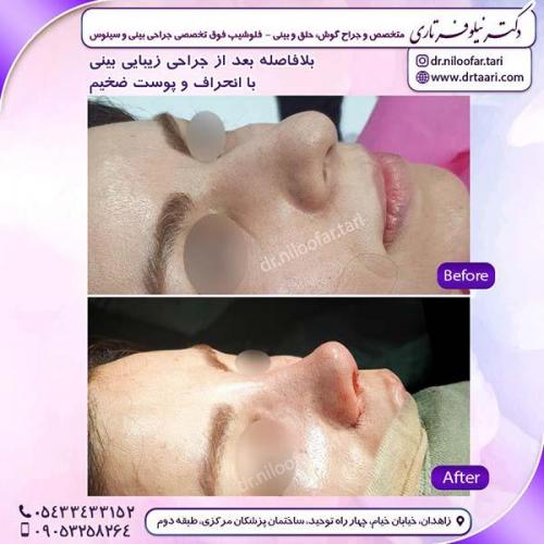 جراحی-بینی-210