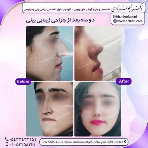 جراحی-بینی-211
