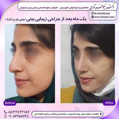 جراحی-بینی-212