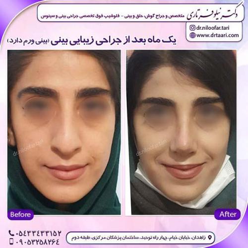 جراحی-بینی-213