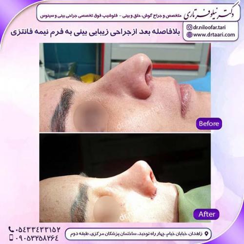 جراحی-بینی-214