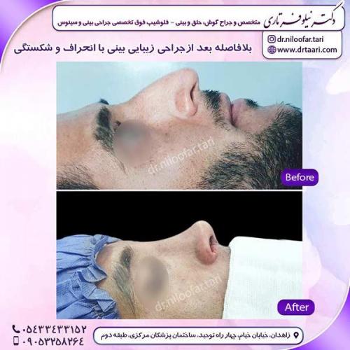 جراحی-بینی-215