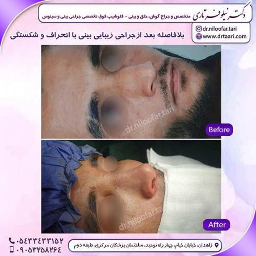 جراحی-بینی-216