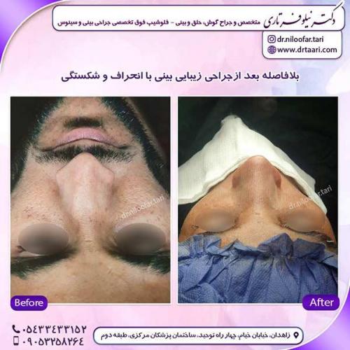 جراحی-بینی-217