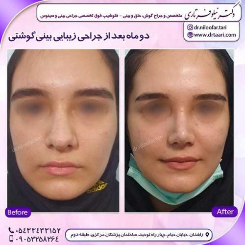 جراحی-بینی-218
