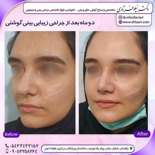 جراحی-بینی-219