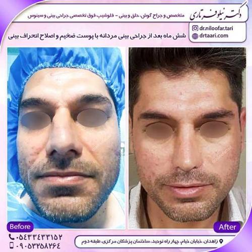 جراحی-بینی-22