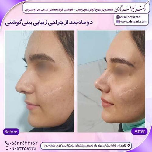جراحی-بینی-220