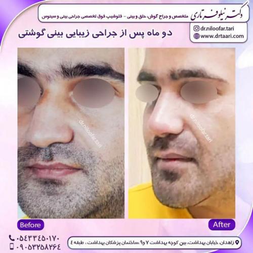 جراحی-بینی-220 (1)