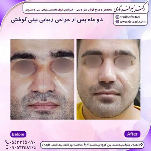 جراحی-بینی-221 (1)