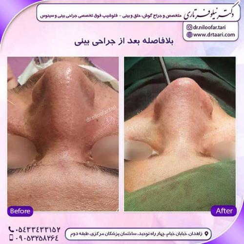 جراحی-بینی-222