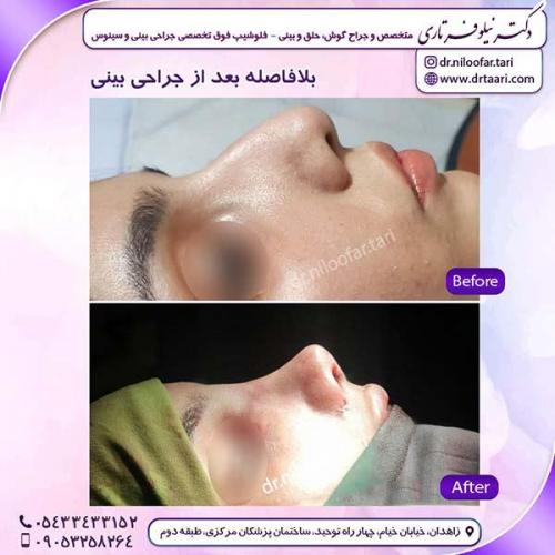 جراحی-بینی-223