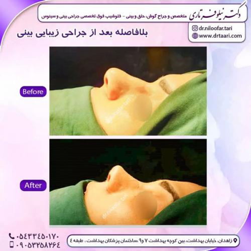 جراحی-بینی-223 (1)