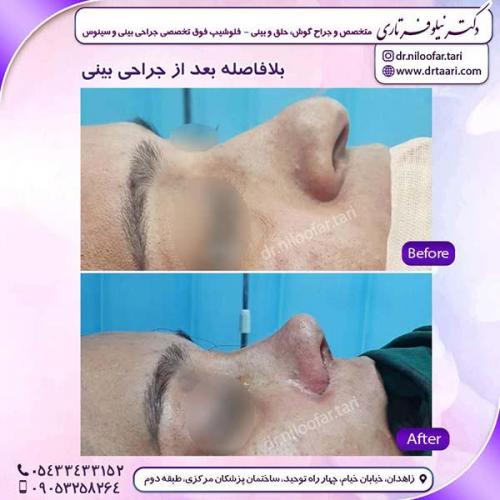 جراحی-بینی-224