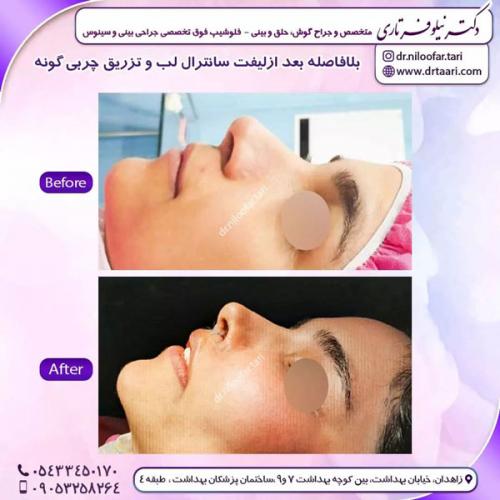 جراحی-بینی-224 (1)