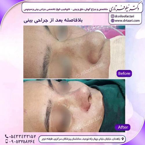 جراحی-بینی-225