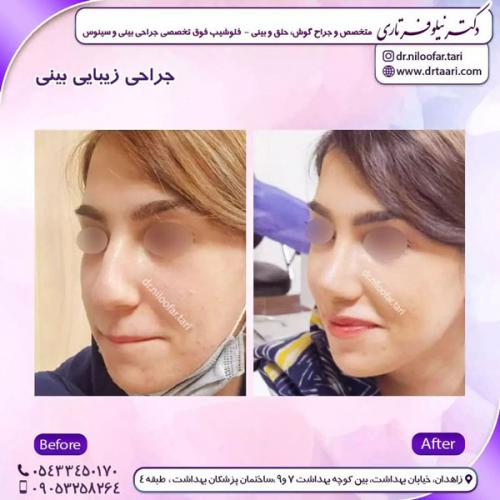 جراحی-بینی-225 (1)