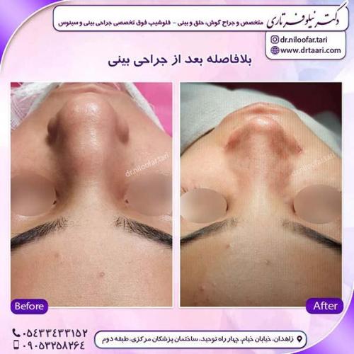 جراحی-بینی-226
