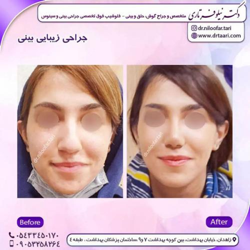 جراحی-بینی-226 (1)