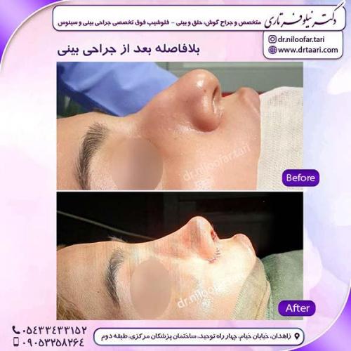 جراحی-بینی-227