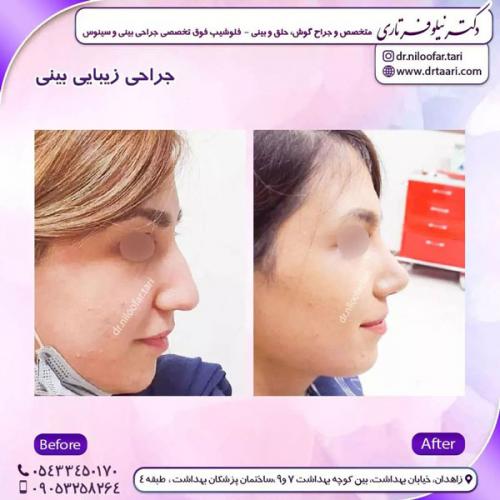 جراحی-بینی-227 (1)