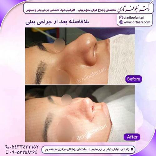 جراحی-بینی-228
