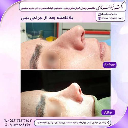 جراحی-بینی-229