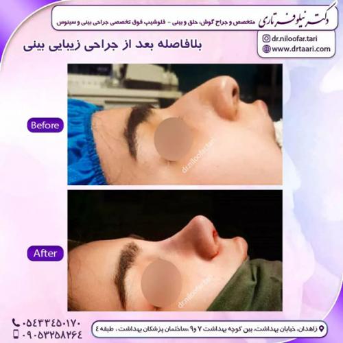 جراحی-بینی-229 (1)