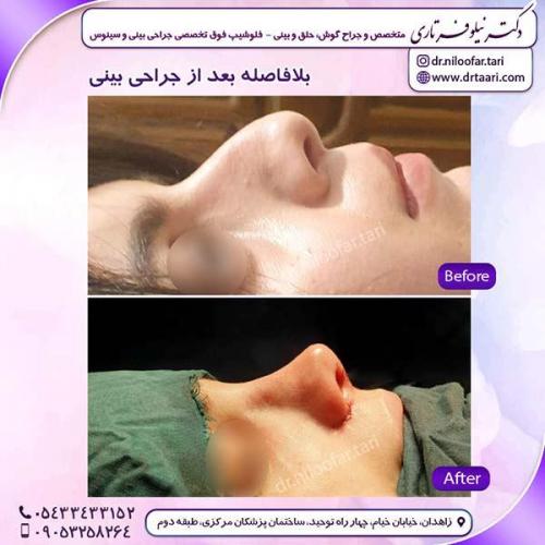 جراحی-بینی-230