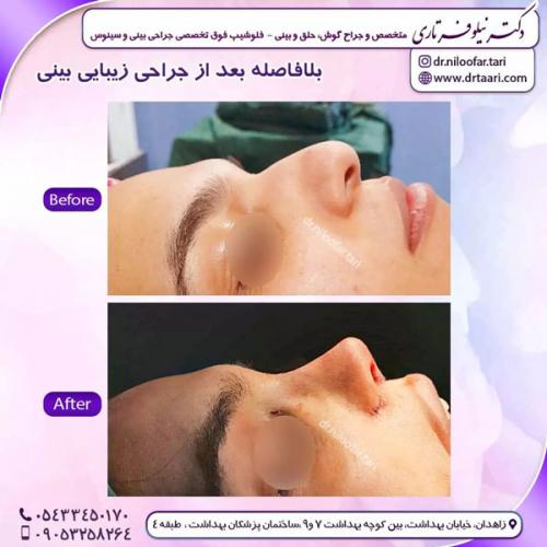 جراحی-بینی-230 (1)