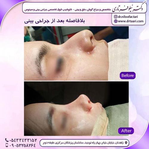 جراحی-بینی-231